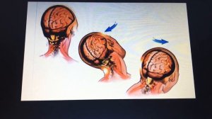 Ушиб головного мозга,  часть 1