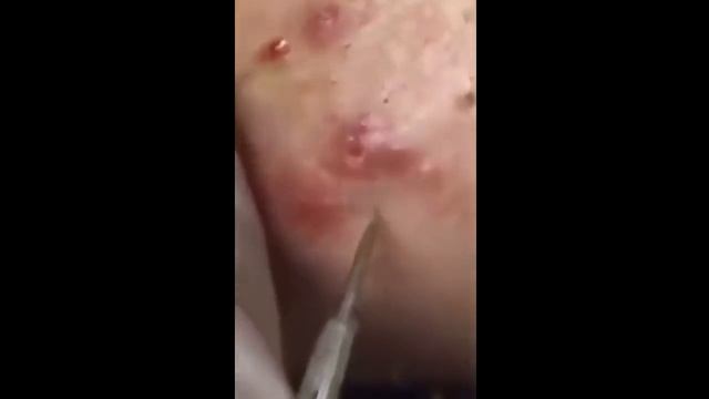 Subcutaneous acne for many years | 수년간 피하 여드름 | Подкожные прыщи на протяжении многих лет | смотреть онлайн