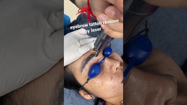 eyebrow tattoo remove by laser смотреть онлайн