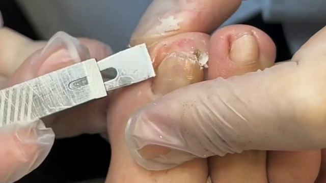 Chinese Professional Pedicure/tickle Feet/Ingrown/nails/레 푸스/#Ingrown #Pedicure #toenails 292【ASMR】