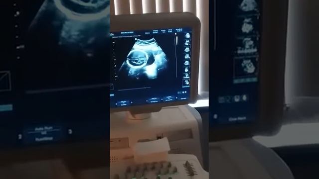 21 нед. Киста сосудистого сплетения смотреть онлайн
