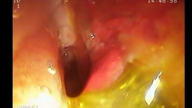 Стриктура терминального отдела холедоха/ Duodenal Papilla Tumor смотреть онлайн