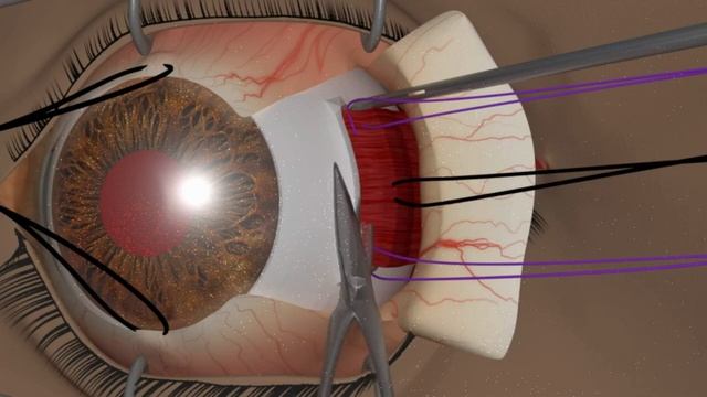 Профессор Яир Морад: Может ли косоглазие вернуться после операции? смотреть онлайн