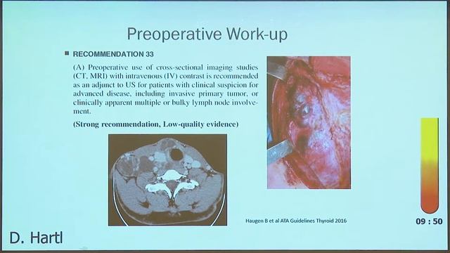 Lymph Node Dissection Indications and Extent D Hartl смотреть онлайн