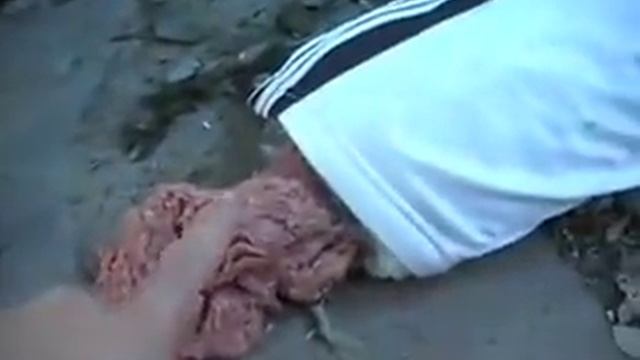 Worst Compound Fracture Ever! смотреть онлайн