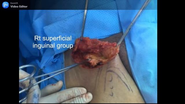 Scrotal SCC with bilateral inguinal lymph node dissection смотреть онлайн