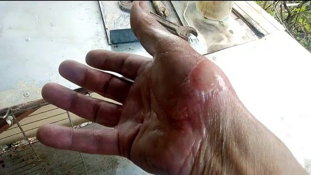 Озонированное масло при ожогах. Бутылка с розжигом взорвалась в руке. смотреть онлайн