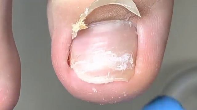 Very long toenails, protect the health of ingrown nails【Xue Yidao】 смотреть онлайн