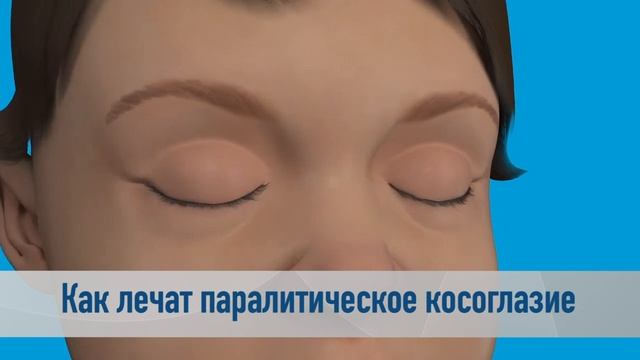 Паралитическое косоглазие. Как лечить? - Отвечает профессор Яир Морад смотреть онлайн