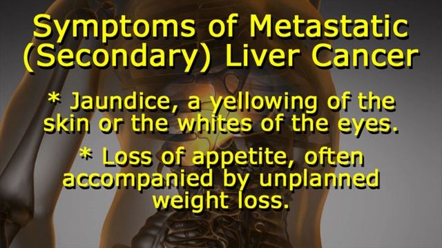 Liver Cancer Metastasis: What Are The Of Secondary Liver Cancer? смотреть онлайн