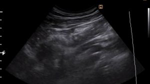 УЗИ почек, конкремент мочеточника