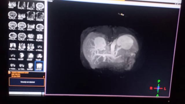 MRI Dynamic contrast liver 3 phases смотреть онлайн