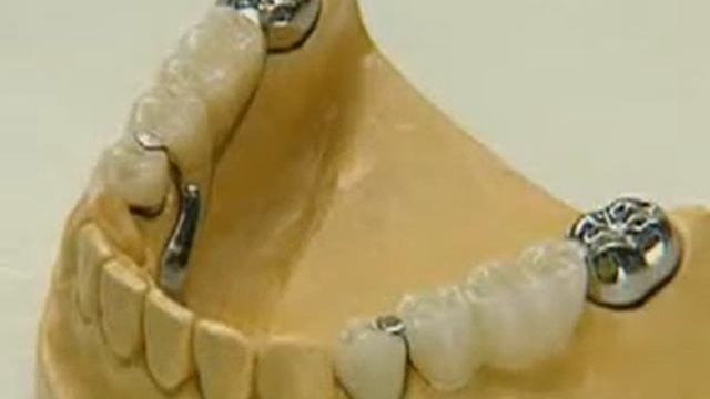 Протез с балочным аттачменом - Съемный протез смотреть онлайн