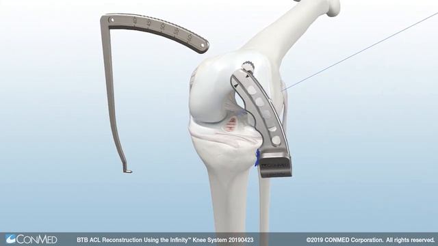 BTB ACL Reconstruction Using the Infinity™ Knee System - CONMED Animation смотреть онлайн