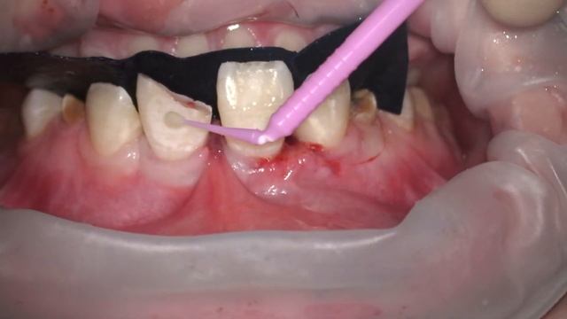 Отсроченная реплантация при полном вывихе смотреть онлайн