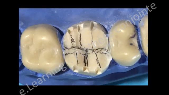 PREPARATION DE LA MOLAIRE SUPERIEURE EN VUE DE RECEVOIR UNE COURONNE CERAMO METALLIQUE смотреть онлайн