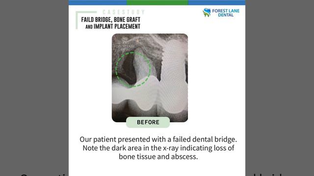 [Forest Lane Dental] Case Study: Failed Bridge, Bone Graft and Implant Placement смотреть онлайн