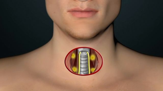 Thyroid Surgery to Remove Nodule Suspicious for Cancer смотреть онлайн