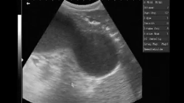 cystis pancreas смотреть онлайн