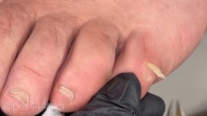 Мозоль на пальце