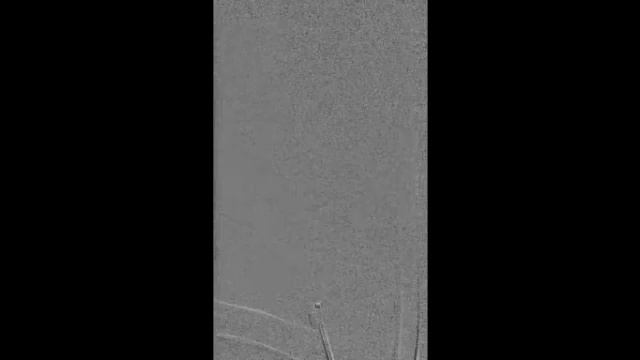 Тромбоэкстракция из правой ВСА 1 смотреть онлайн