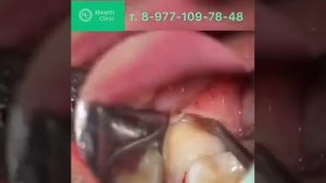 Удаление зуба мудрости