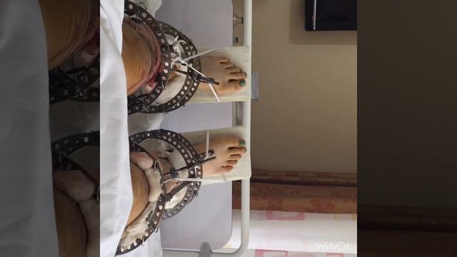 Кривые ноги( исправление кривизны ног) смотреть онлайн