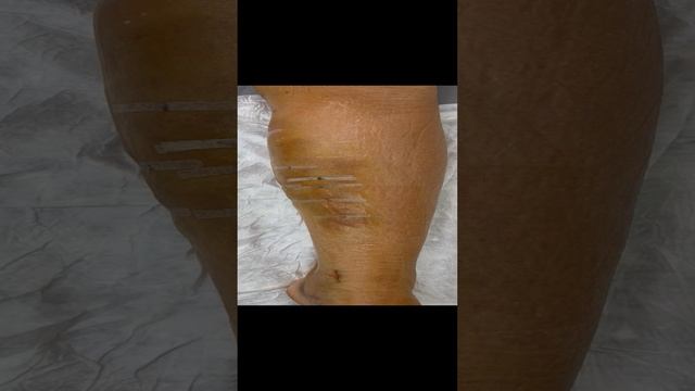 Нога после операции по удалению варикозной вены. Операция. Лечение варикоза. Флеболог Москва смотреть онлайн