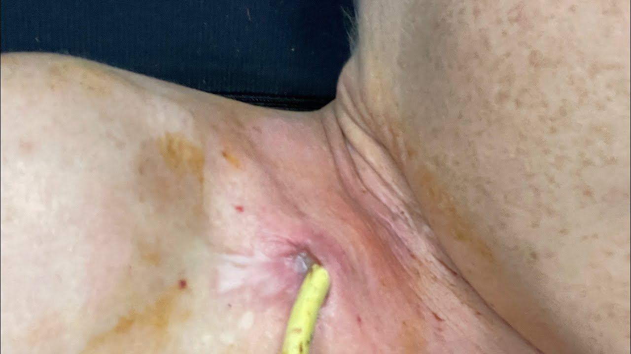 На этом Все! загноился катетер гной пошел в предсердие смотреть онлайн