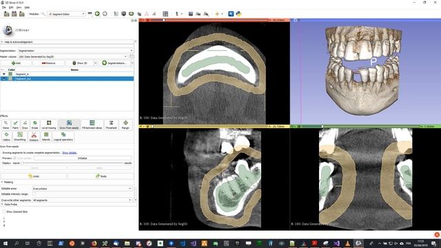 Tutorial: How To Create STL segmentation from DICOM using 3D Slicer (Virteasy Dental / Editor) смотреть онлайн