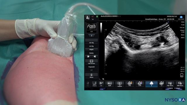 PENG BLOCK FOR HIP PAIN - NYSORA's Regional Anesthesia Clinical Cases