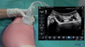 PENG BLOCK FOR HIP PAIN - NYSORA's Regional Anesthesia Clinical Cases