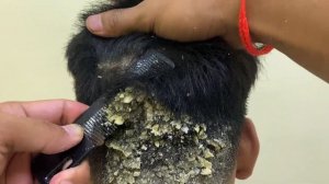 DRY SCALP !! Big Flakes Dandruff Scratching Satisfying Video #768