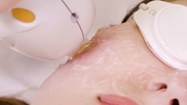 IPL Photofacials At Beleza, Pittsburgh's Medi-Spa