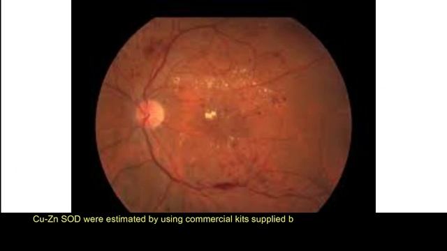 Diabetic Retinopathy: Role of Oxidative Stress and Antioxidant Defence System смотреть онлайн