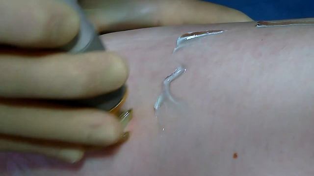 Удаление сосудистых сеточек неодимовым лазером Cutera