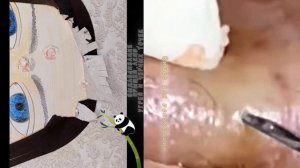 Выдавливание черных точек, угрей и прыщей. #антистресс#залипашки#асмр