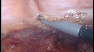 Лапароскопическая резекция сигмовидной кишки