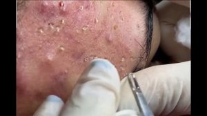 Удаление черных точек 2021