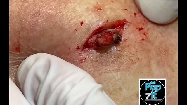 Double barrel blackheads Dilated pores of winer. Blackhead pop. Big squeeze. Cyst excision. Cyst po смотреть онлайн