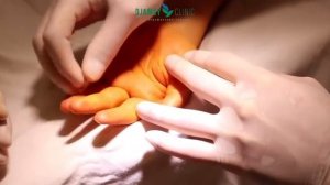 стенозирующий лигаментит 3 пальца левой кисти