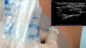 Надключичная блокада плечевого сплетения