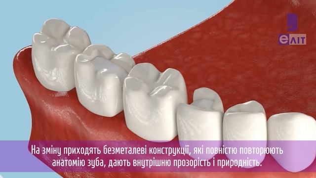 Что такое вкладки на зубы | какие есть виды вкладок на зуб | вкладки коронки