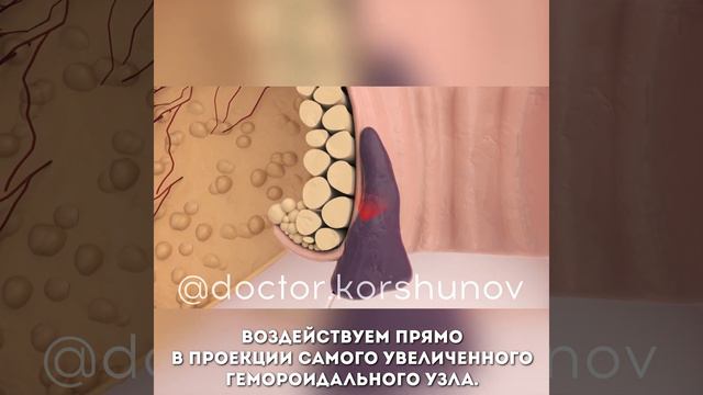 Лазер при геморрое смотреть онлайн
