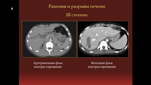 Михайловская Е.М. «Неотложная КТ-диагностика ранений печени и селезёнки» смотреть онлайн