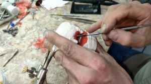 Изготовление бюгельного протеза  Постановка искусственных зубов