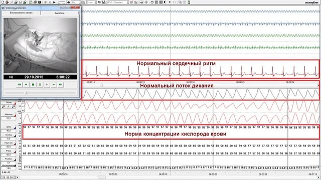 Как выглядит сипап-терапия? Терапевтическая ночь с сипап-аппаратом. смотреть онлайн