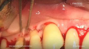 Открытый кюретаж