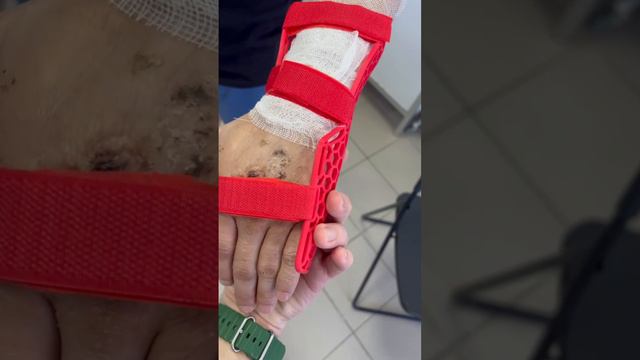 Реабилитация бойцов СВО, зD-печать ланцетов и протезов. смотреть онлайн