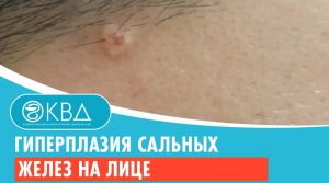 ?? Гиперплазия сальных желез на лице. Клинический случай №1003